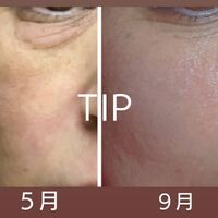 画像1528：TIPハーブピーリング