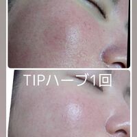 画像1530：TIPハーブピーリング