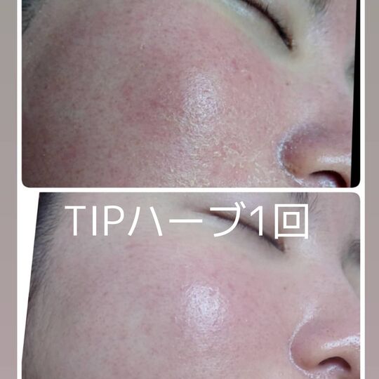 画像1530：TIPハーブピーリング