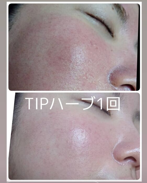 画像1530：TIPハーブピーリング
