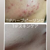 画像1532：TIPハーブピーリング