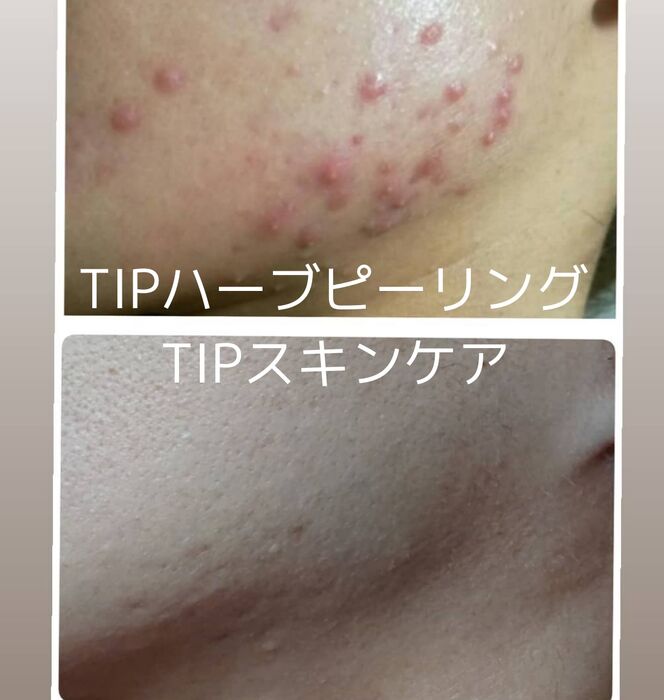 画像1532：TIPハーブピーリング